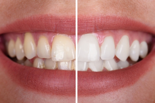 Digital Smile Design