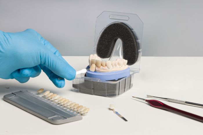 Edelprovisorium im Unterkiefer und Oberkiefer bei Implantaten