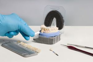 Edelprovisorium im Unterkiefer und Oberkiefer bei Implantaten