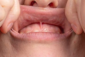 Das Lippenbändchen – Wann eine kleine Korrektur sinnvoll ist