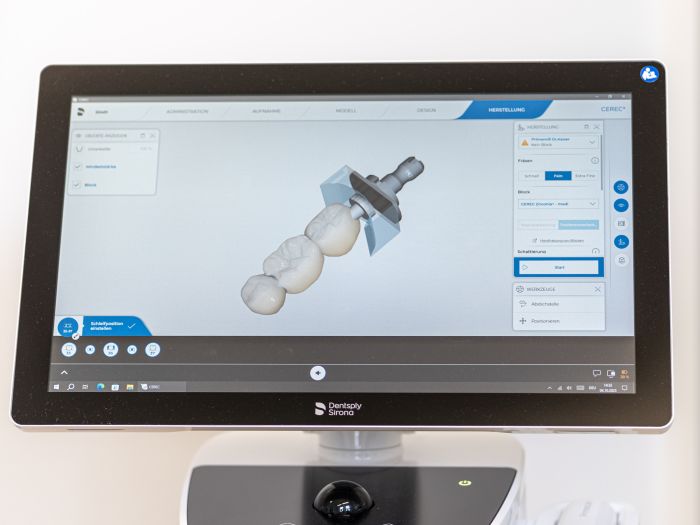 CEREC – Häufige Fragen einfach erklärt