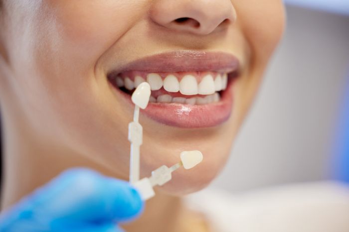 Keramikveneers oder Komposit? – Was passt besser zu Ihnen?