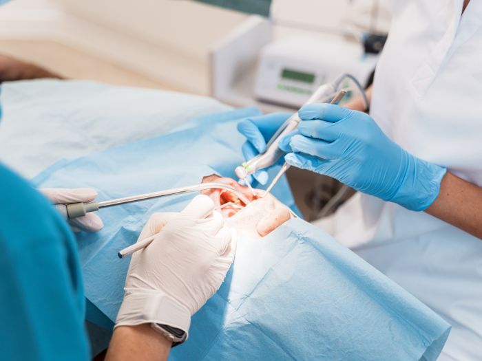 Wie setzt man ein Implantat? – Schritt-für-Schritt erklärt