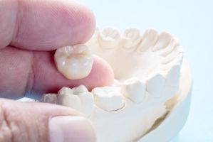 Keramikkronen – Wann lohnen sie sich wirklich?
