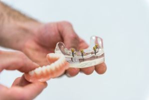 Fester Halt trotz herausnehmbarer Prothese – Die Lösung mit Implantaten