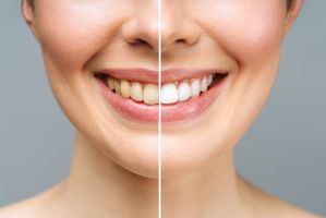 Sinuslift und Implantat – wie lange dauert es bis zum festen Zahn?