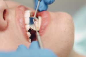 Sinuslift und Implantat – wie lange dauert es bis zum festen Zahn?