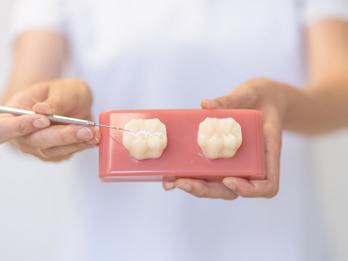 Fissurenversiegelung – wirksamer Schutz vor Karies