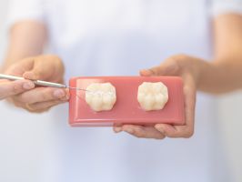 Fissurenversiegelung – wirksamer Schutz vor Karies