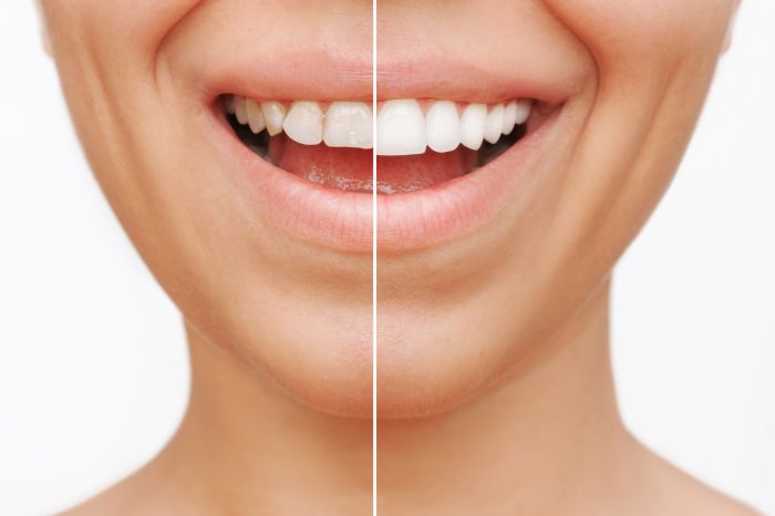 Keramik-Veneers