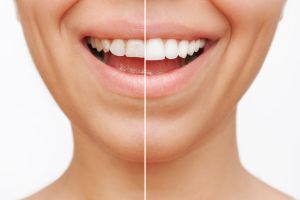 Keramik-Veneers