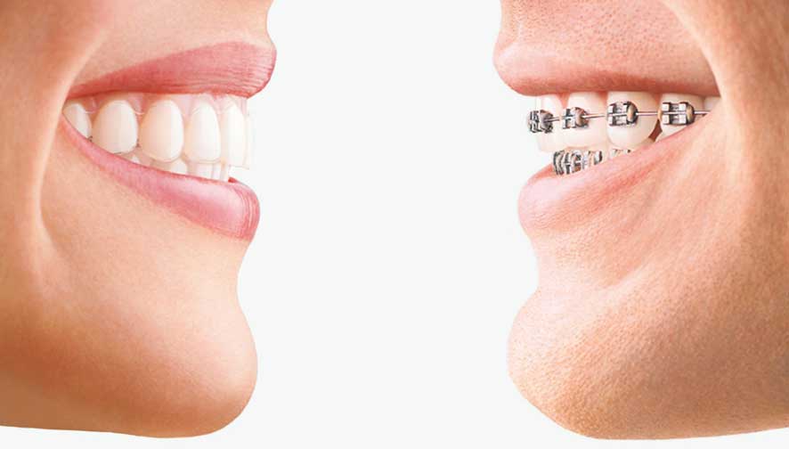 Foto: Vergleich herkömmliche und unsichtbare Zahnspange - Invisalign vom Zahnarzt im Burgenland, zwischen Mattersburg und Eisenstadt