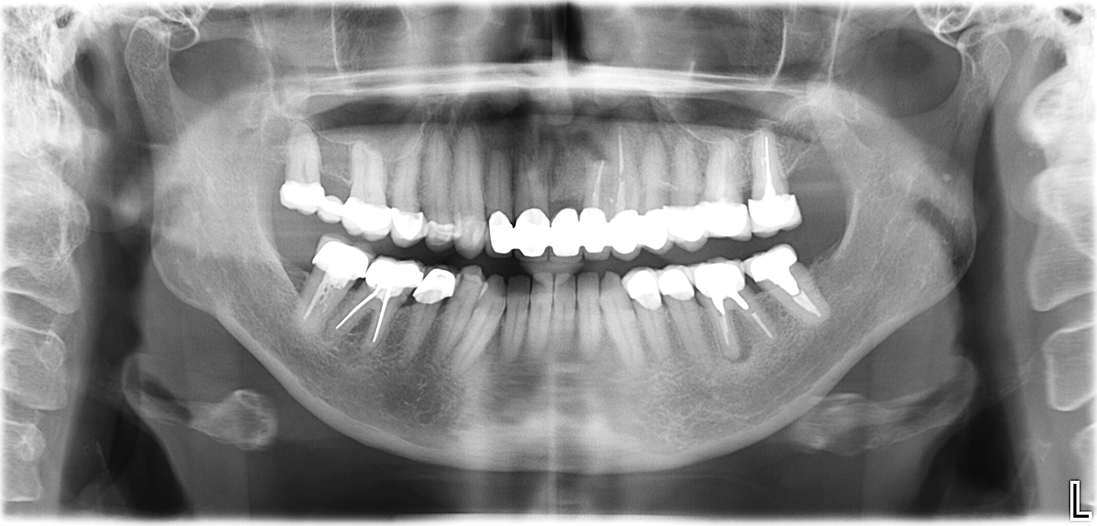Ablauf einer Implantatbehandlung, 1. Schritt