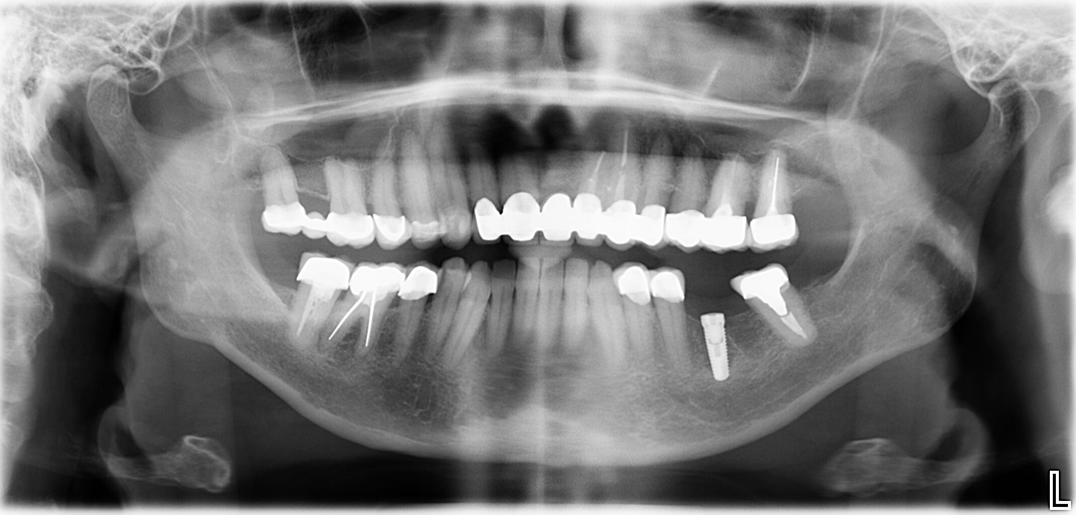 Ablauf einer Implantatbehandlung, 2. Schritt
