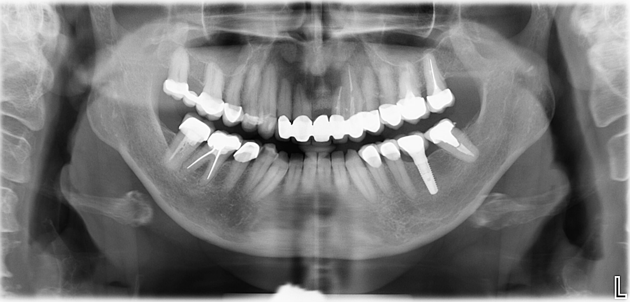 Ablauf einer Implantatbehandlung, 3. Schritt
