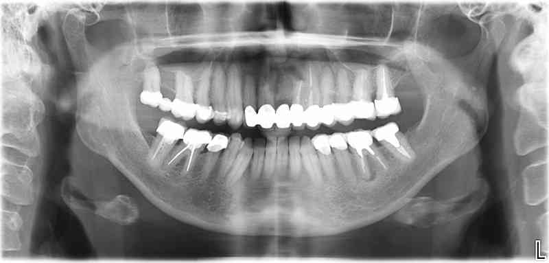 Ausgangssituation: Zahn 36 mit apikaler Beherdung, nicht erhaltungswürdig