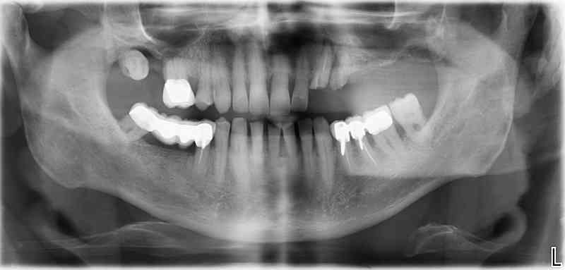 Ausgangssituation: Zahn 23/24 nicht erhaltungswürdig, Zahnentfernung durchgeführt