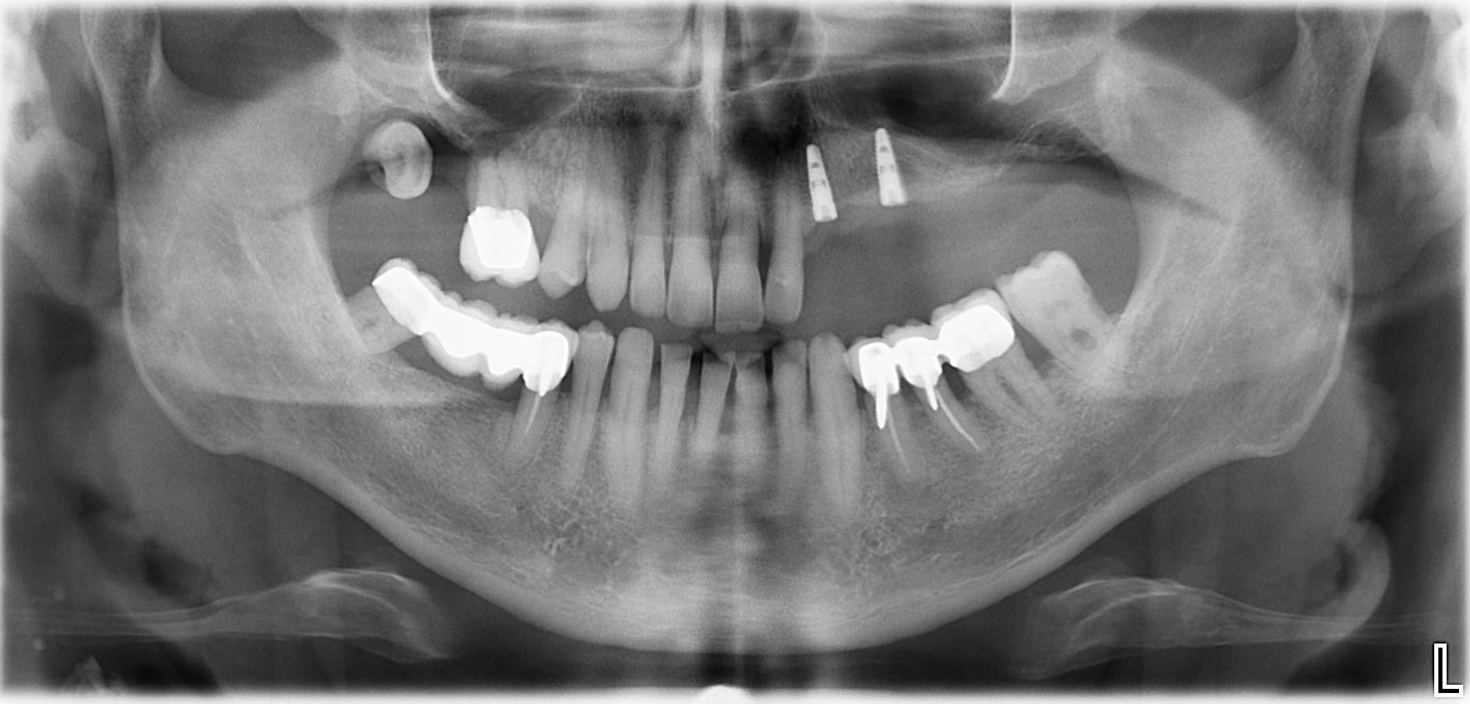 St. p. Implantation regio 23/25 (nach 3 Monaten Abheilphase)