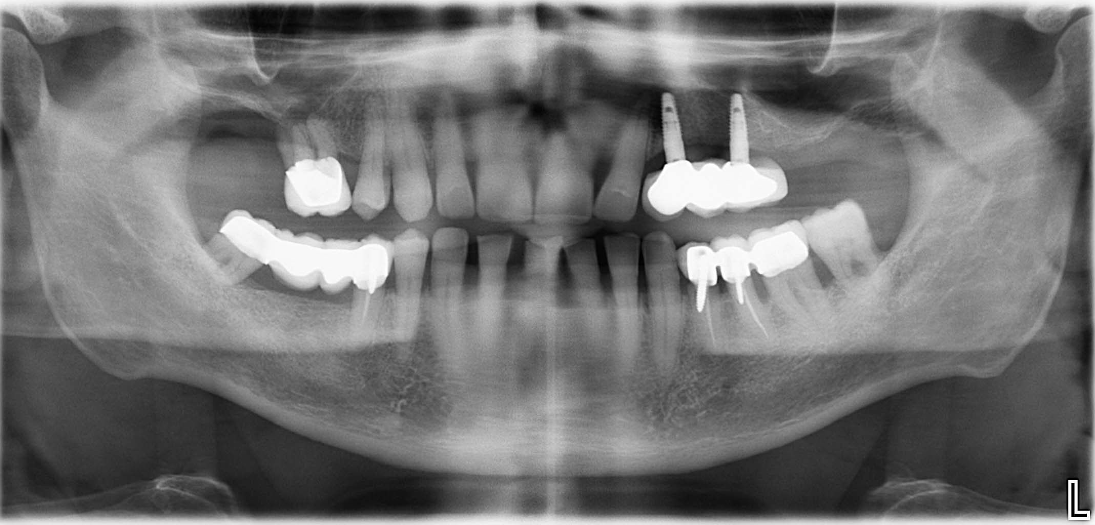 Endsituation: Implantatgetragene Brückenversorgung (vollanatomisch gefräst)