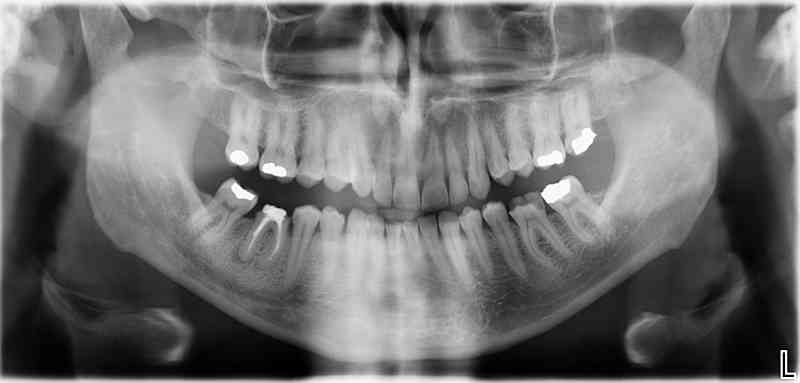 Ausgangssituation: Zahn 46 mit apikaler Beherdung, nicht erhaltungswürdig; Zahnentfernung durchgeführt + Knochenaufbau (Socket Preservation)