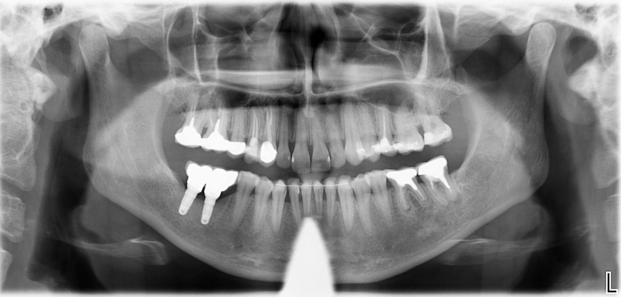 Endsituation: Implantatprothetischer Zahnersatz aus Zirkonoxid (verblockt) nach horizontalem Knochenaufbau mit simultaner Implantation