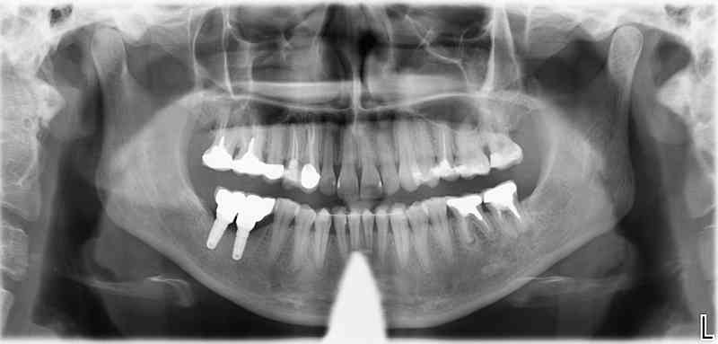 Endsituation: Implantatprothetischer Zahnersatz aus Zirkonoxid (verblockt) nach horizontalem Knochenaufbau mit simultaner Implantation