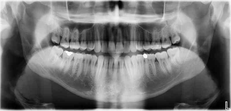 Ausgangssituation: Zahnstatus vor Trauma; Patient verlor in Rahmen eines Traumas Zahn 11 + unkomplizierte Kronenfraktur 21