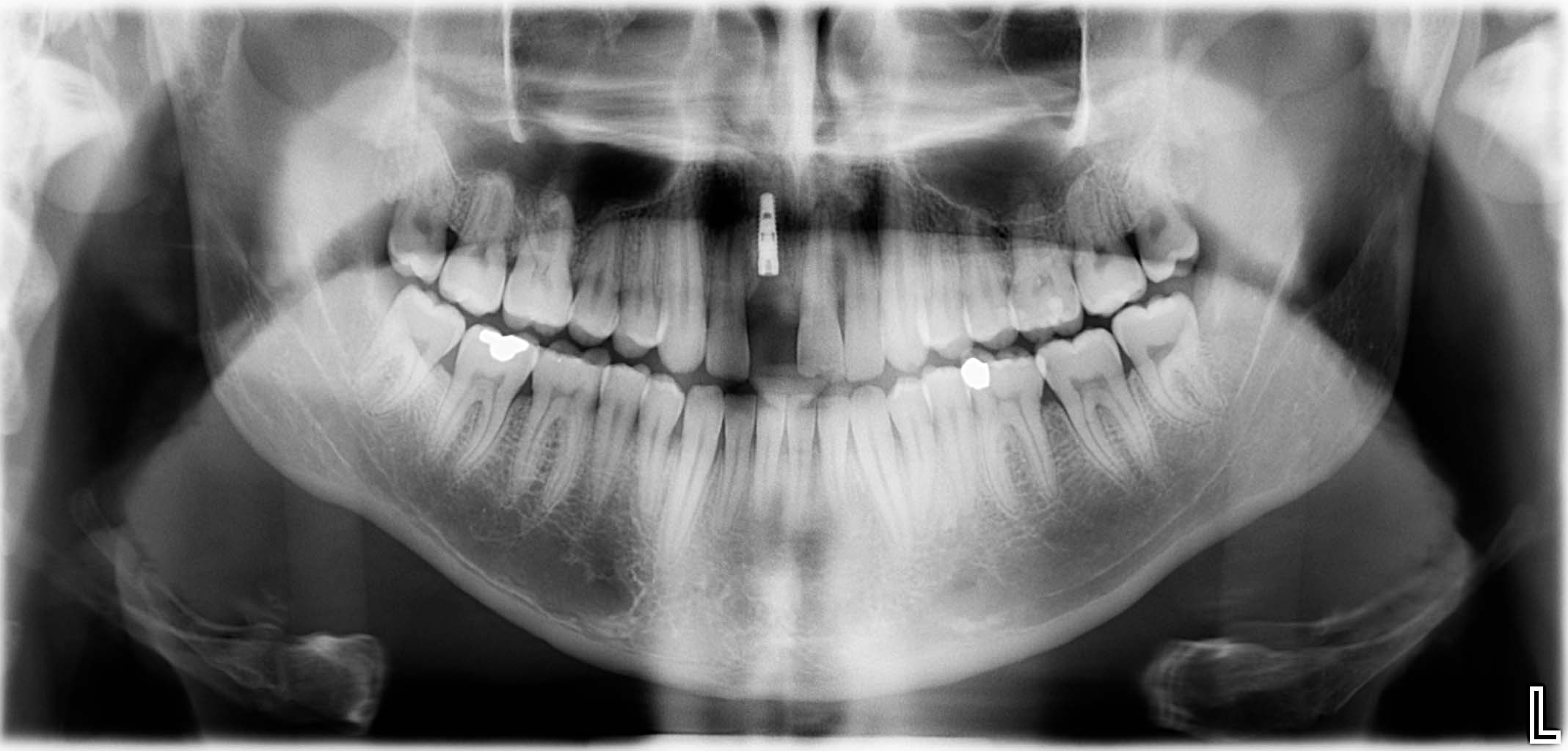 St. p. Implantation regio 11 bei reduziertem Knochenangebot; Knochenaufbau wurde simultan durchgeführt