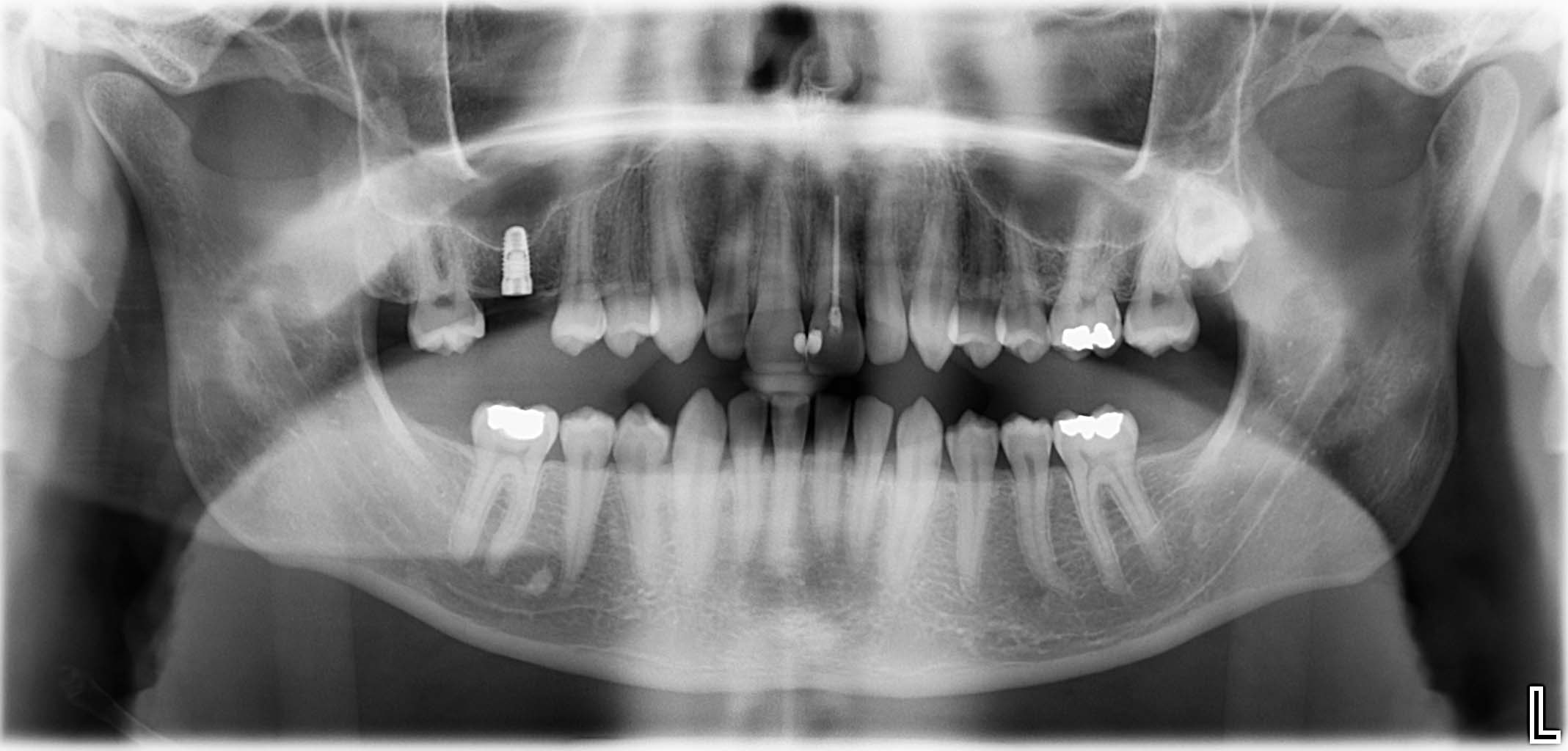St. p. internem Sinuslift + Implantation 16