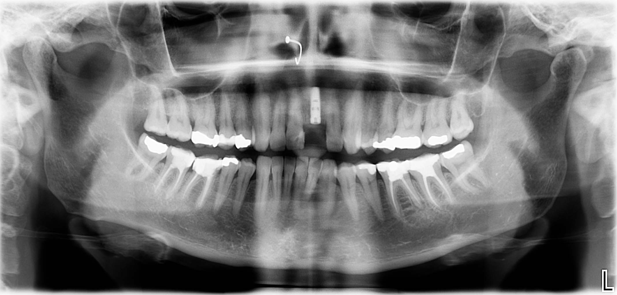 St. p. Zahnextraktion, Knochenaufbau (Socket Preservation) + Implantation (nach 3 Monaten Abheilphase)