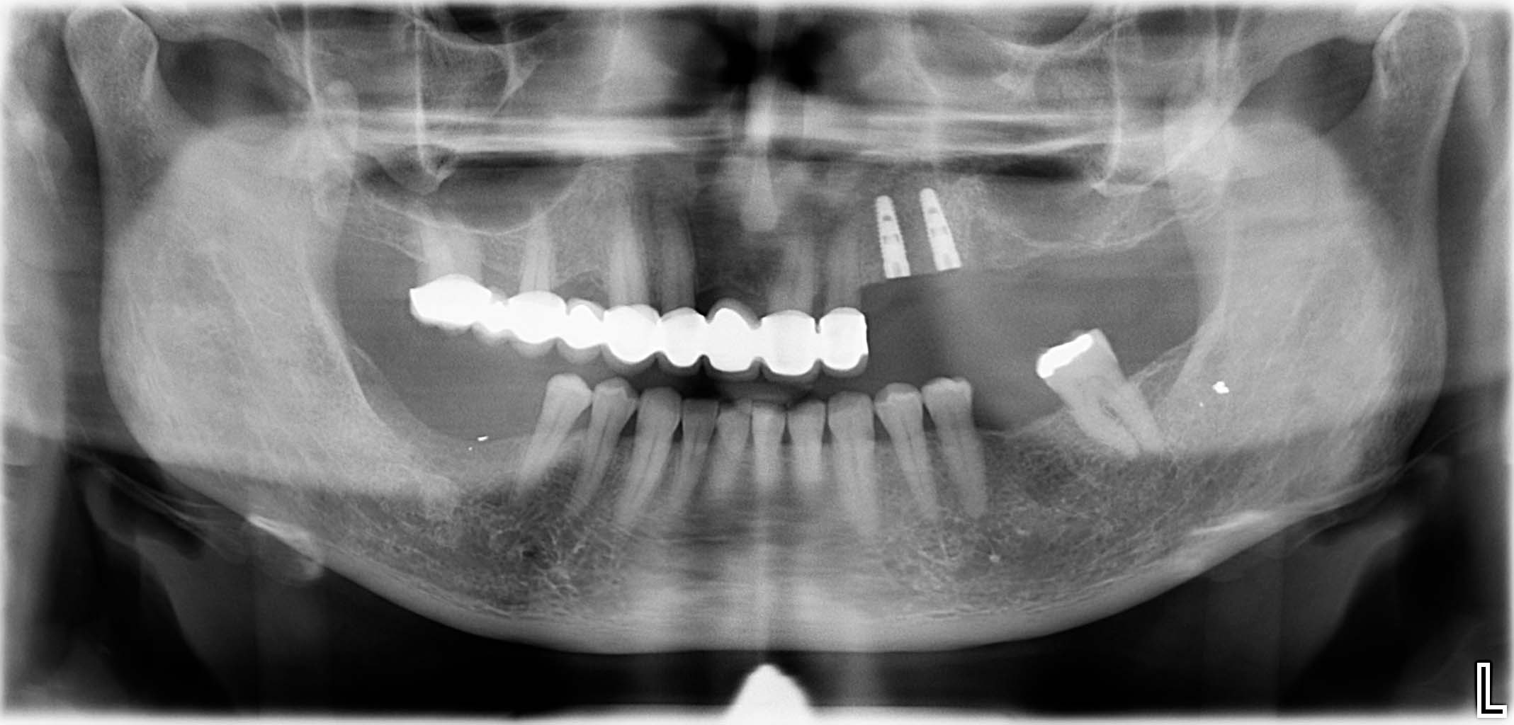 St. p. Implantation regio 23/24