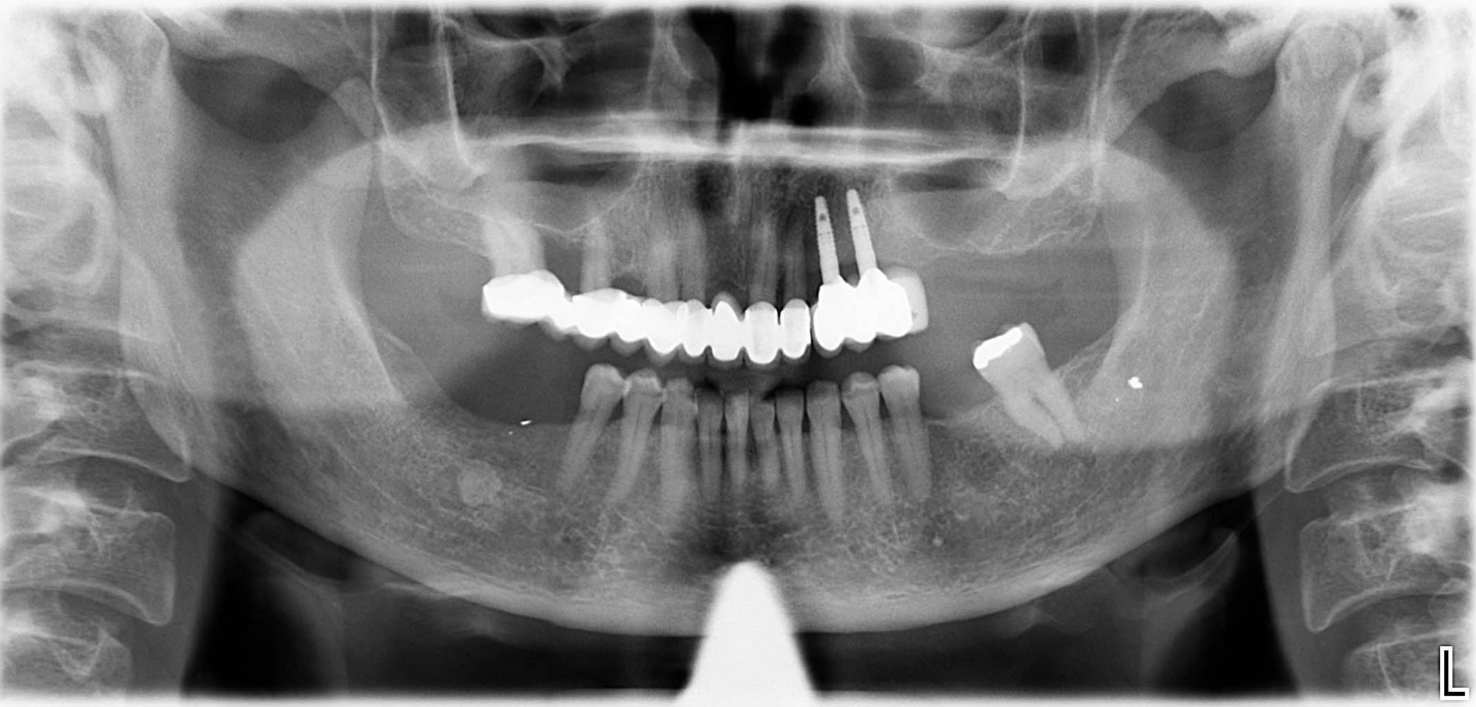Endsituation: Implantatgetragene, vollkeramische Brückenversorgung