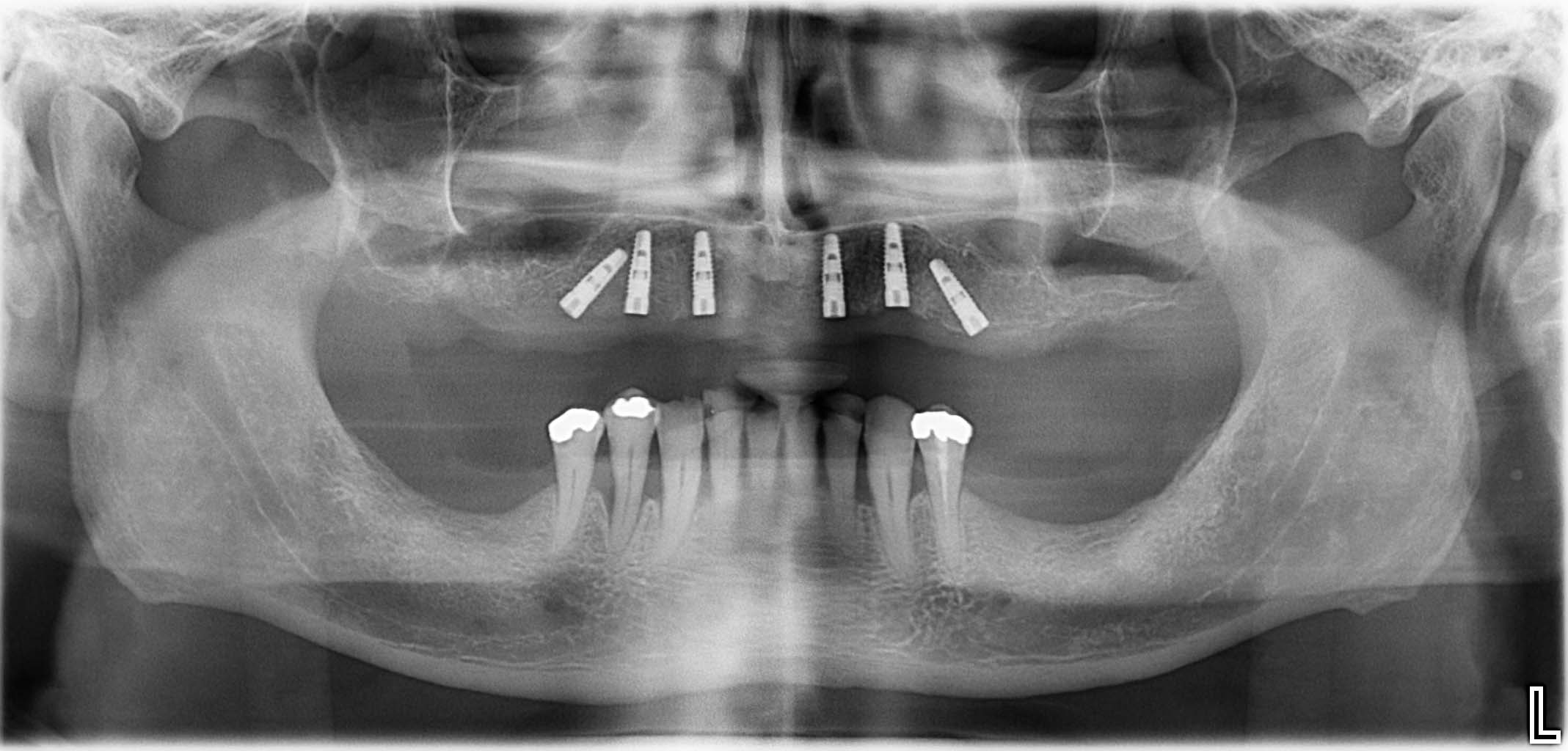 St. p. konservative Parodontaltherapie Unterkiefer, Serienextraktion Oberkiefer mit Knochenaufbauten & Implantation von 6 Implantaten für anschließende festsitzende Brückenversorgung (Versorgung folgt)
