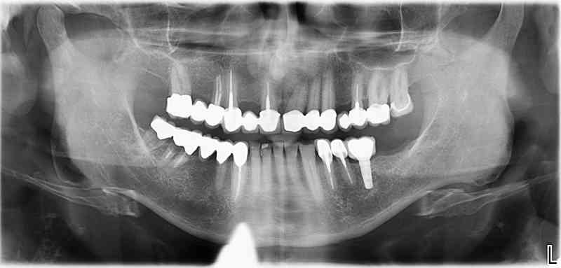 Endsituation: Zahn 37 wurde entfernt; Lücke 36: Implantologischer Einzelzahnersatz mit Vollkeramikkrone