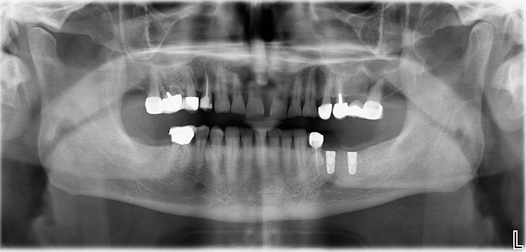 St. p. Implantation 34/35