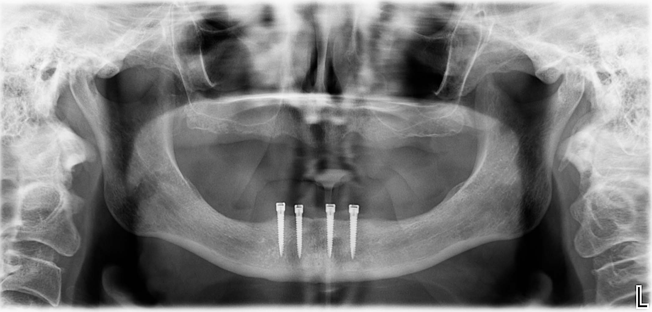 Endsituation: Wiederherstellung eines sehr stabilen Prothesenhalts mittels vier Implantaten + Locator-Aufbauten
