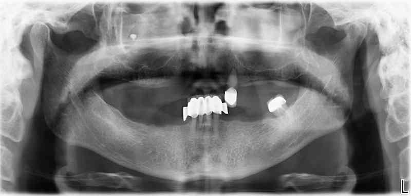 Ausgangssituation: Zahn 23 nicht erhaltungswürdig, nach Extraktion nicht zufriedenstellender Prothesenhalt für Patient