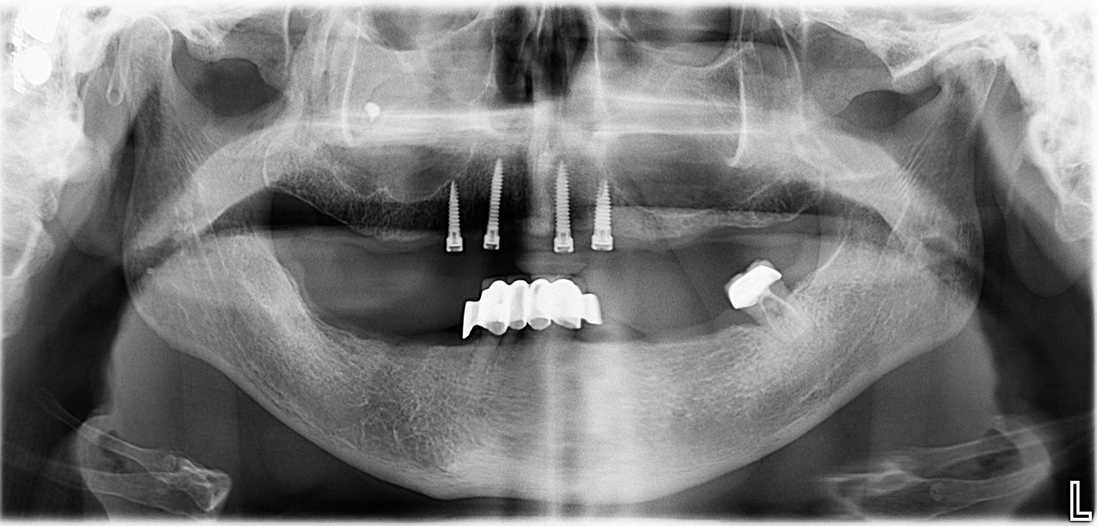 Endsituation: Wiederherstellung eines stabilen Prothesenhalts mittels vier Implantaten + Locator-Aufbauten