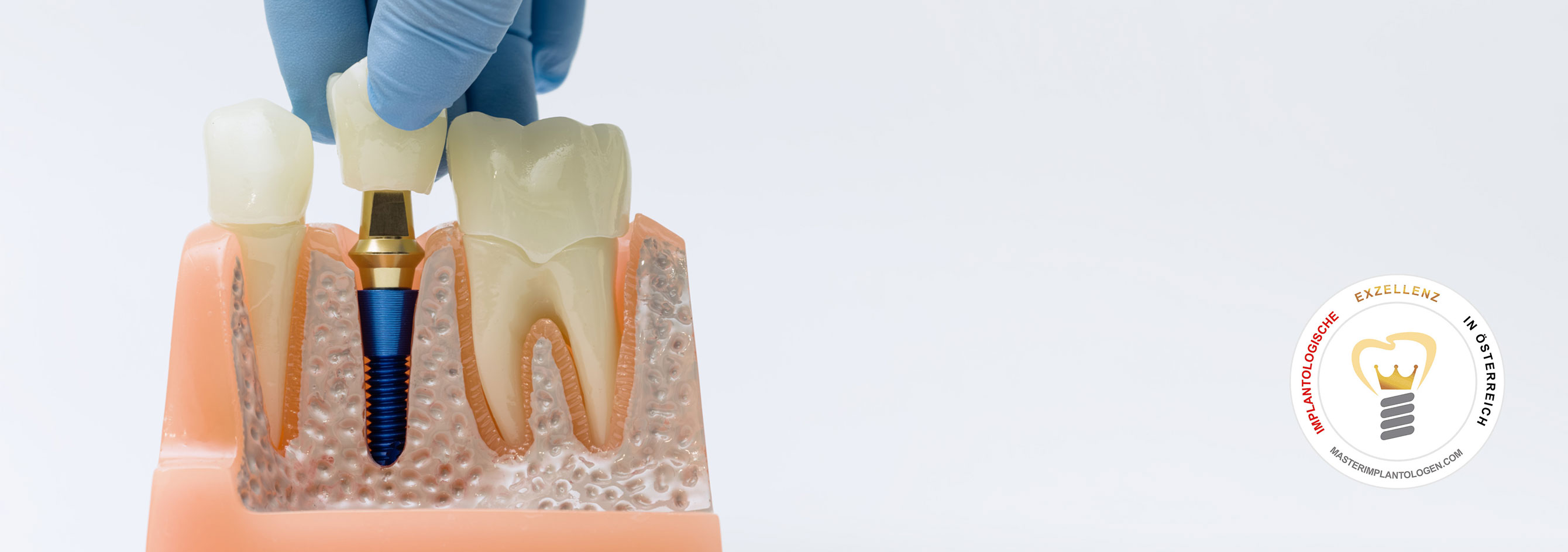 Header-Image zur Leistung Zahnimplantate Burgenland, Eisenstadt, Mattersburg