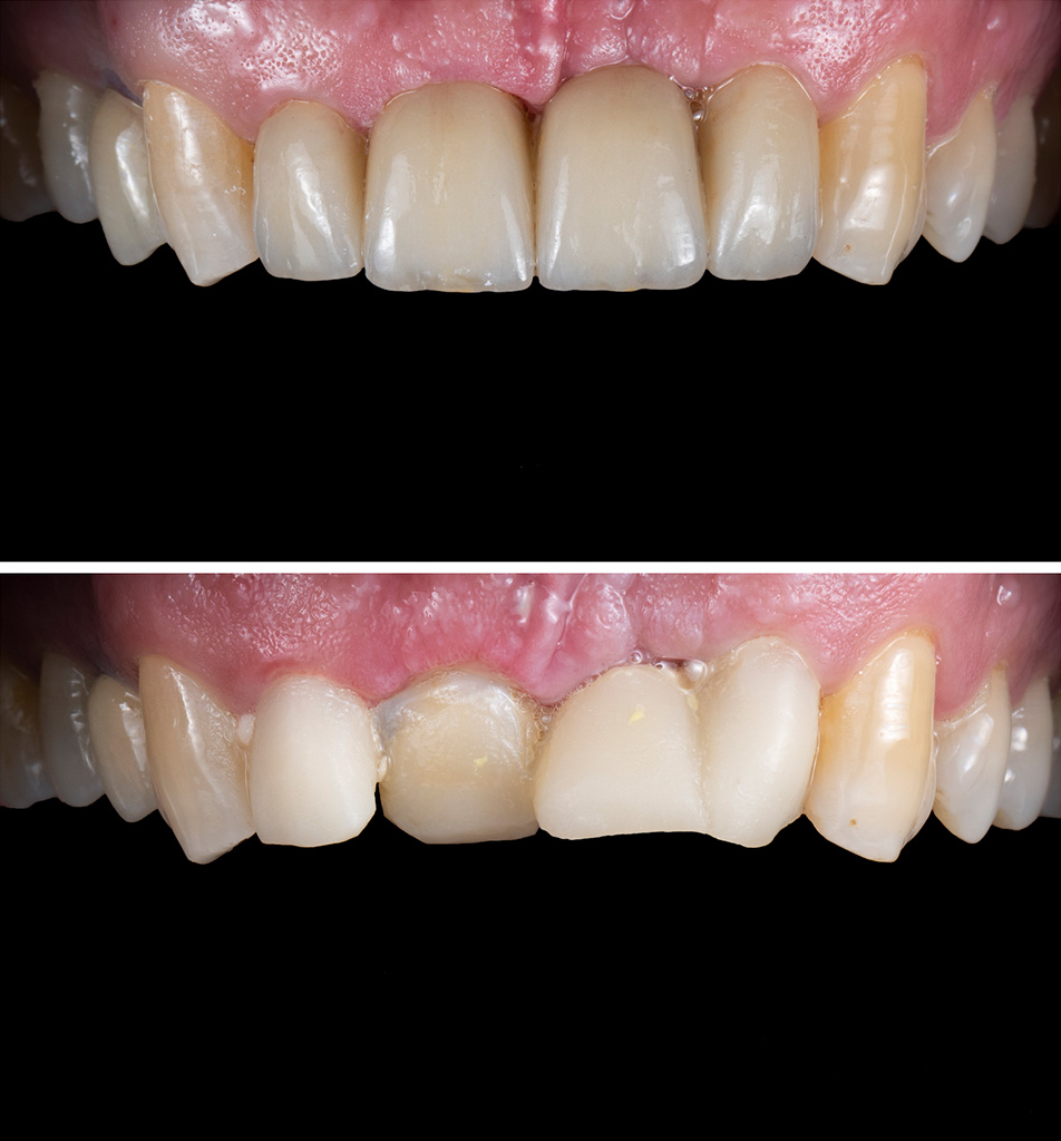 CEREC Behandlungsfall vorher nacher