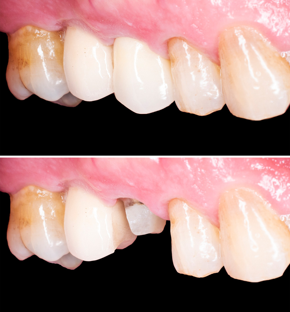 CEREC Behandlungsfall vorher nacher
