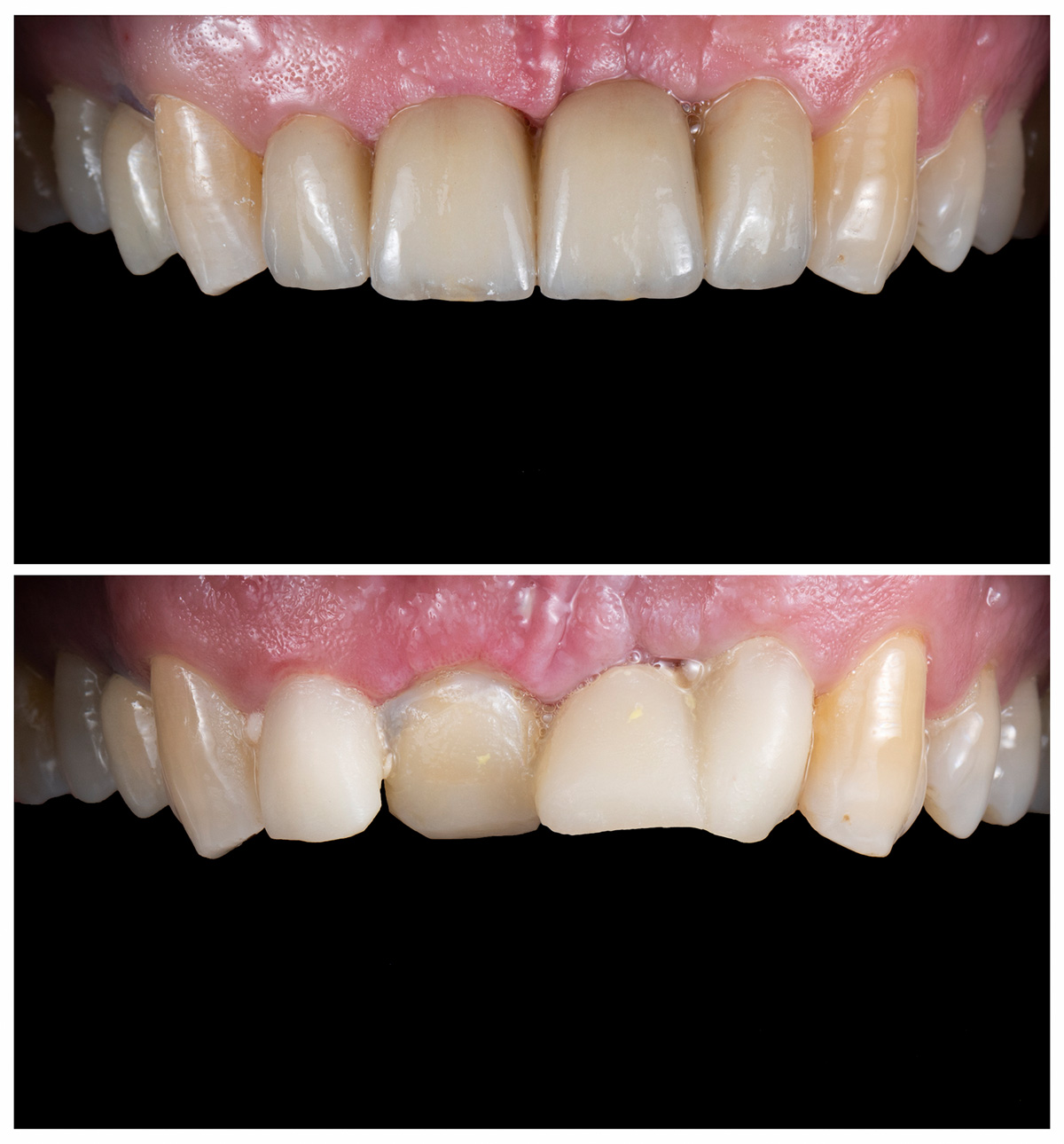 CEREC Behandlungsfall vorher nacher