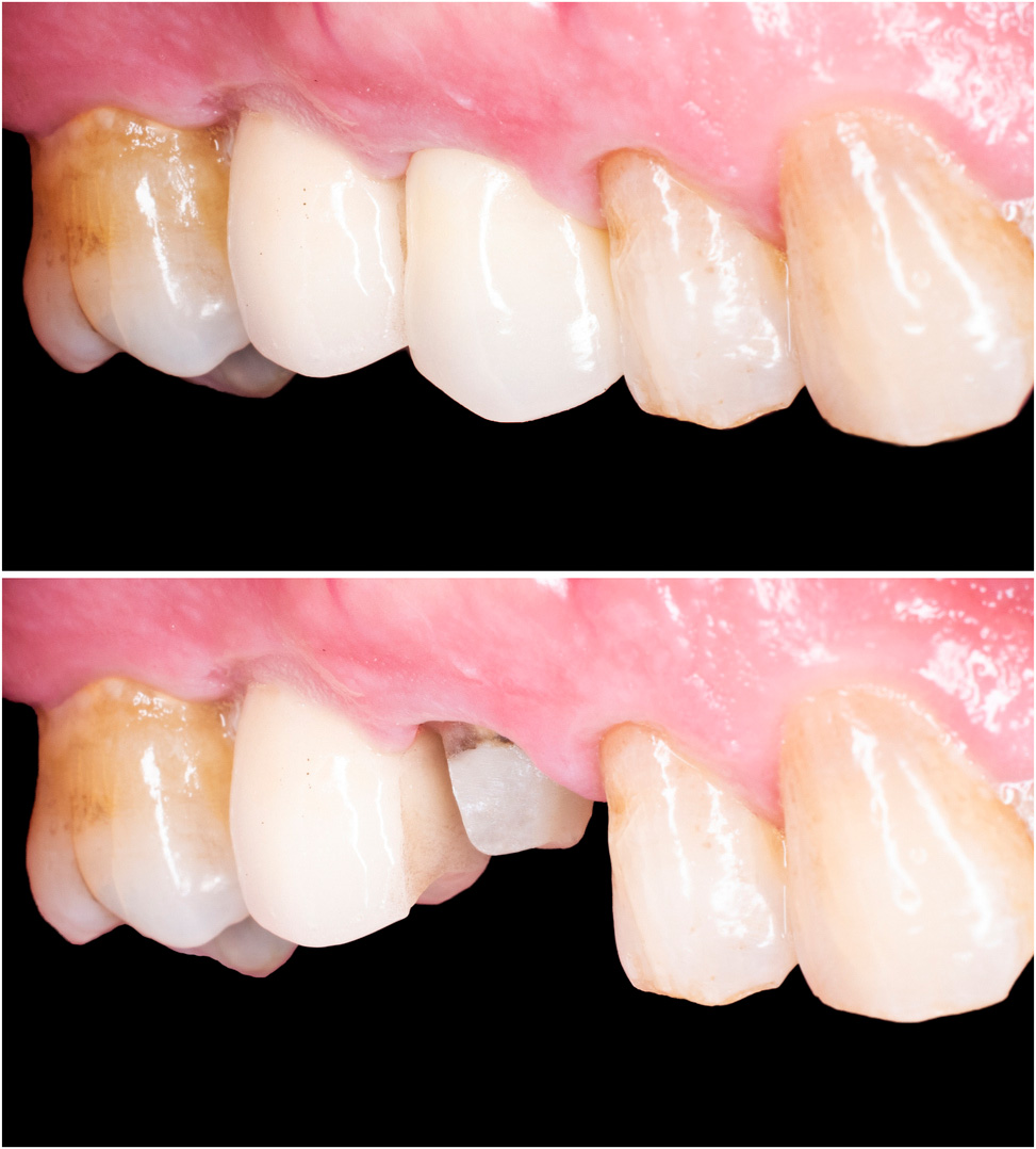 CEREC Behandlungsfall vorher nacher