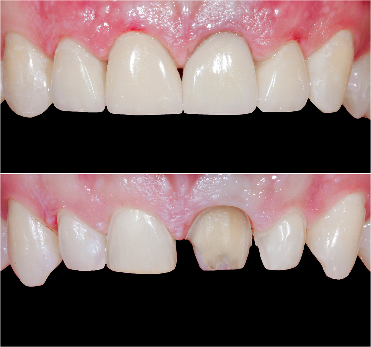 CEREC Behandlungsfall vorher nacher