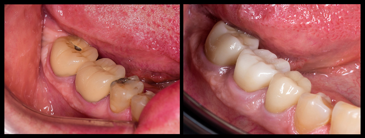 CEREC Behandlungsfall vorher nacher