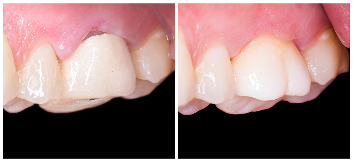 CEREC Behandlungsfall vorher nacher