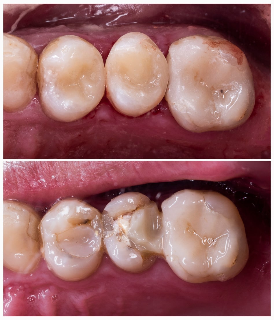 CEREC Behandlungsfall vorher nacher