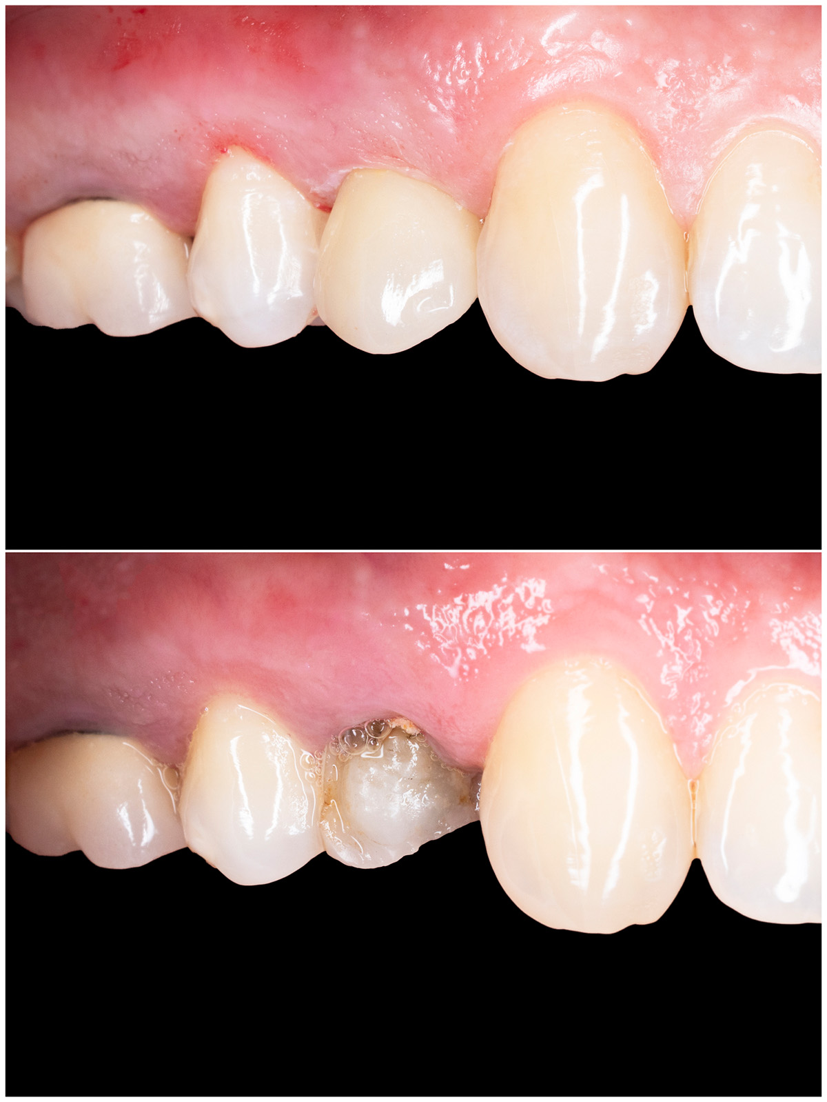 CEREC Behandlungsfall vorher nacher