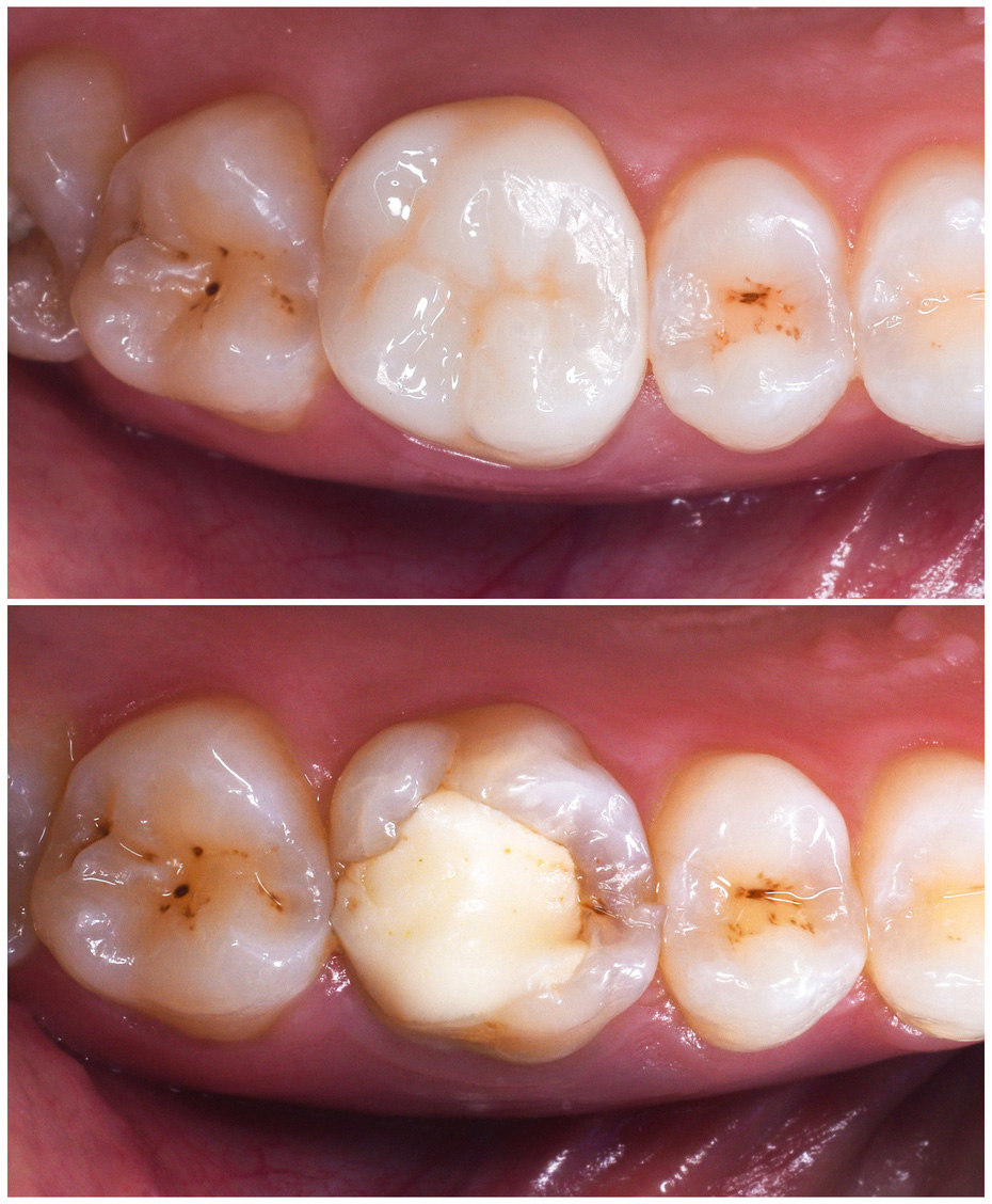 CEREC Behandlungsfall vorher nacher