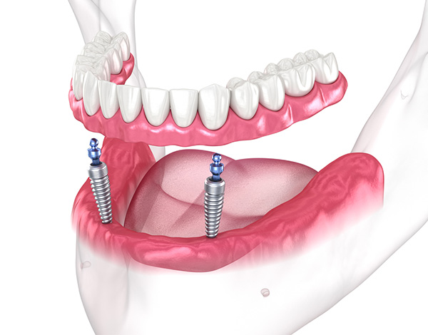 Implantatgetragene Prothese